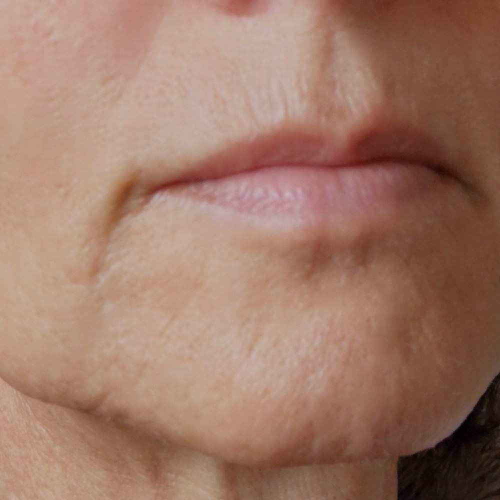 Dieselbe Mundpartie nach der Anwendung des Concentrated Boosters